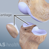 leziunile de cartilaj